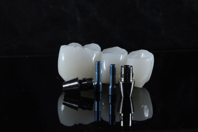 Transform Your Smile with Dental Crowns in Murphy, TX: Expert Dental Insights