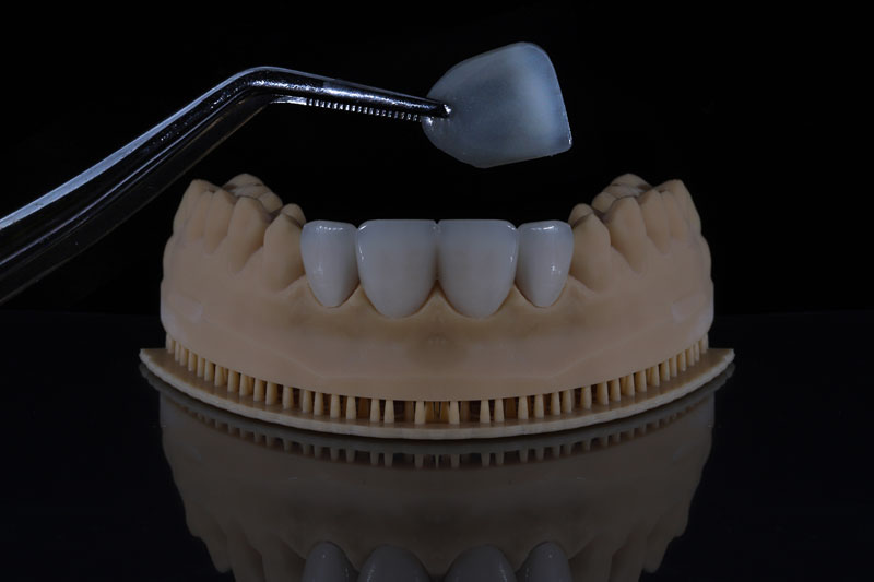 a dental veneer being placed onto a jaw model