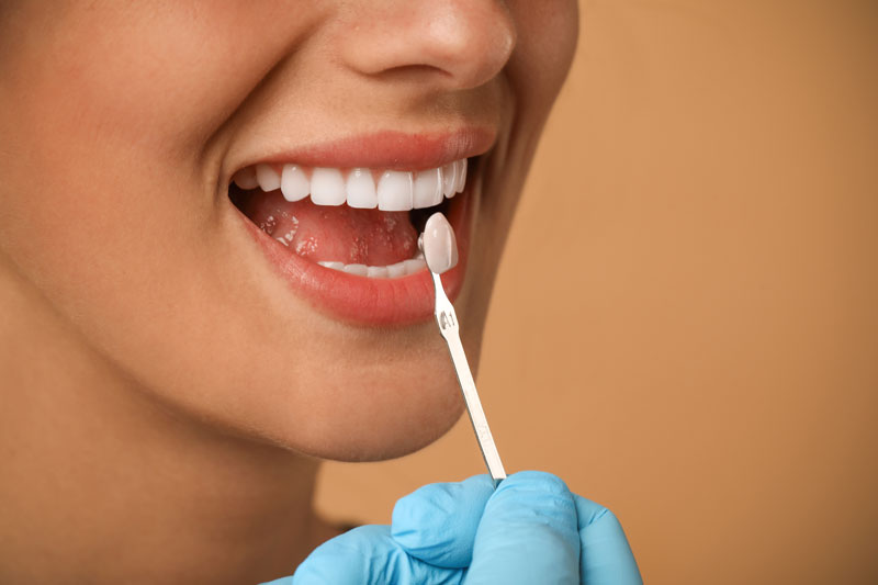 a dental veneer being color matched onto a tooth